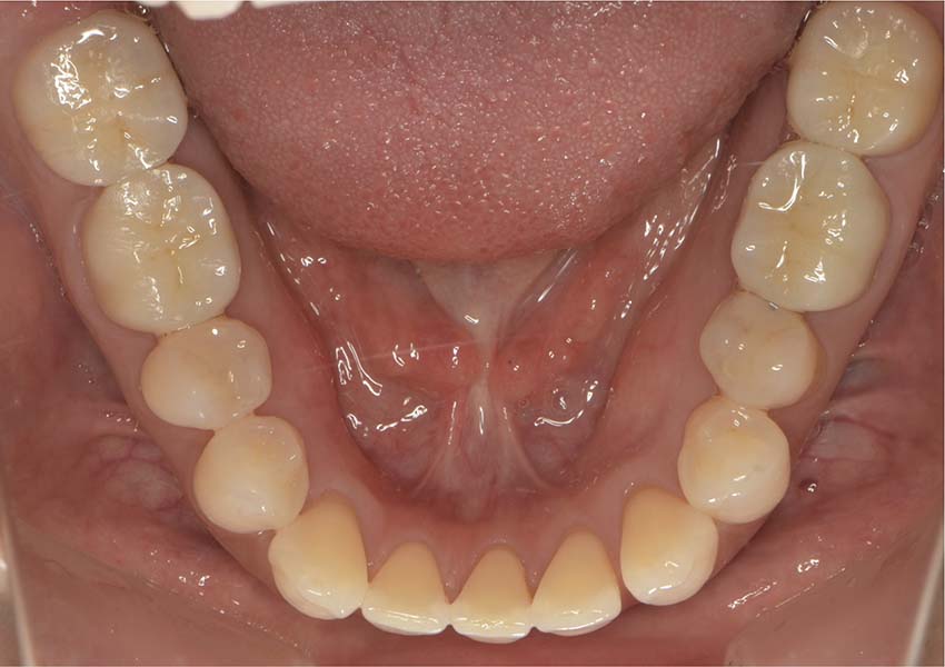 小岩(東京都江戸川区)の歯医者、笠原デンタルオフィスの症例