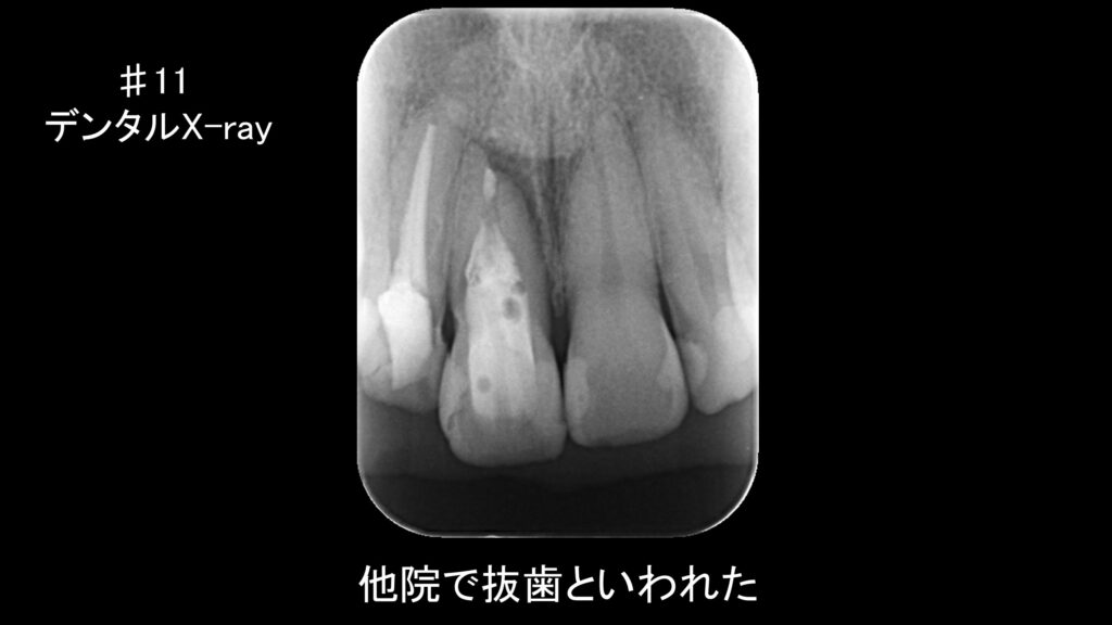 小岩（東京都江戸川区）の歯医者、笠原デンタルオフィスのインプラント症例