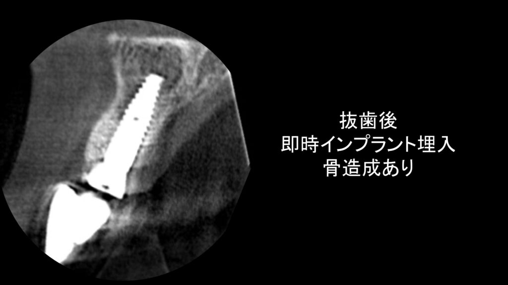 小岩（東京都江戸川区）の歯医者、笠原デンタルオフィスのインプラント症例