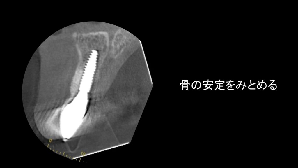 小岩（東京都江戸川区）の歯医者、笠原デンタルオフィスのインプラント症例