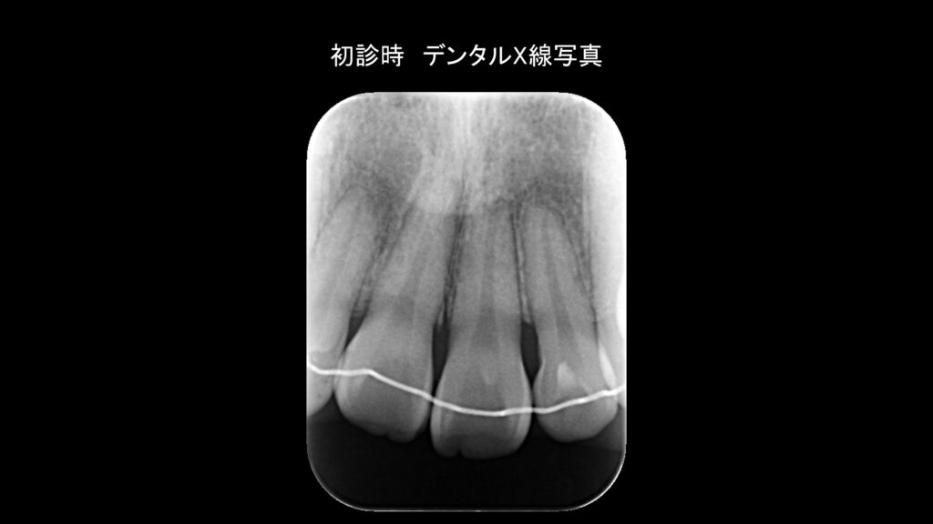小岩（東京都江戸川区）の歯医者、笠原デンタルオフィスの外傷症例