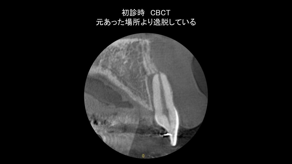 小岩（東京都江戸川区）の歯医者、笠原デンタルオフィスの外傷症例