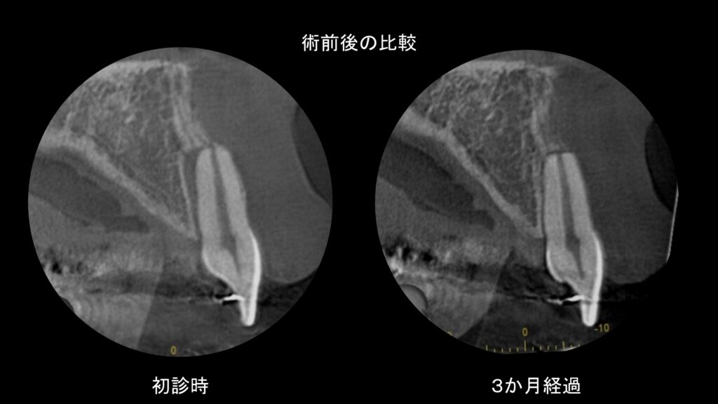 小岩（東京都江戸川区）の歯医者、笠原デンタルオフィスの外傷症例