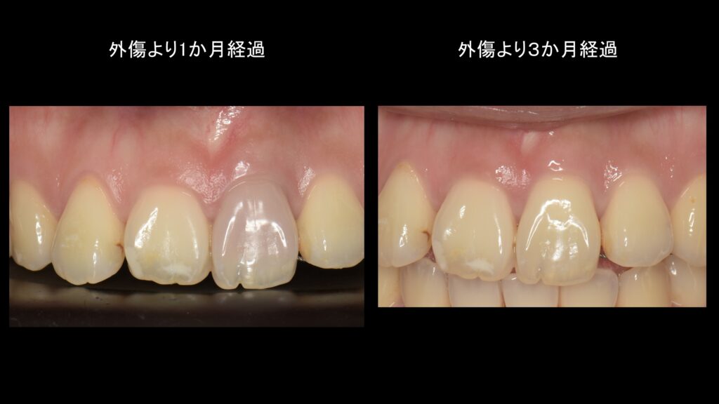 小岩（東京都江戸川区）の歯医者、笠原デンタルオフィスの外傷症例
