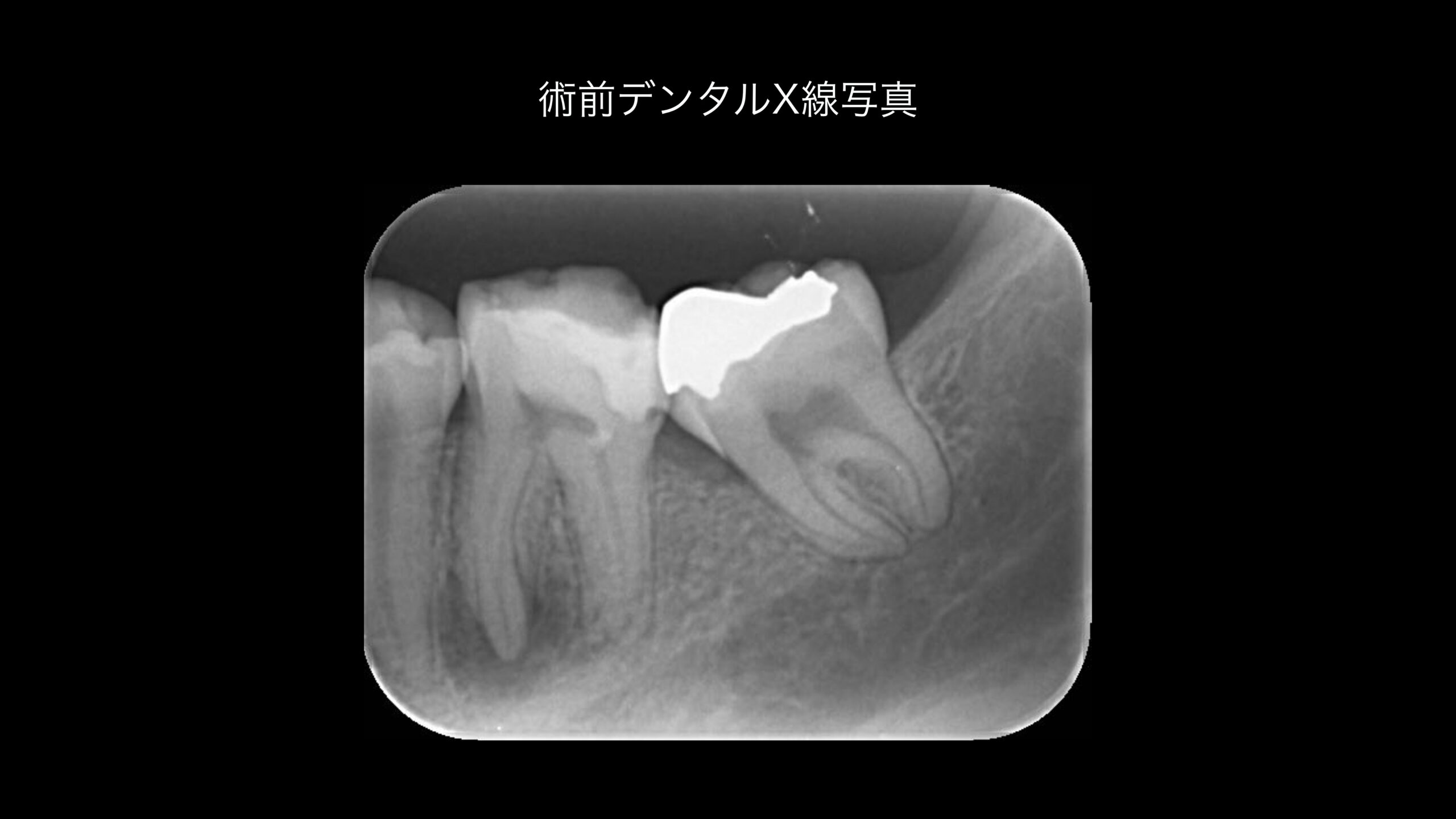 小岩（東京都江戸川区）の歯医者、笠原デンタルオフィスのインプラント症例