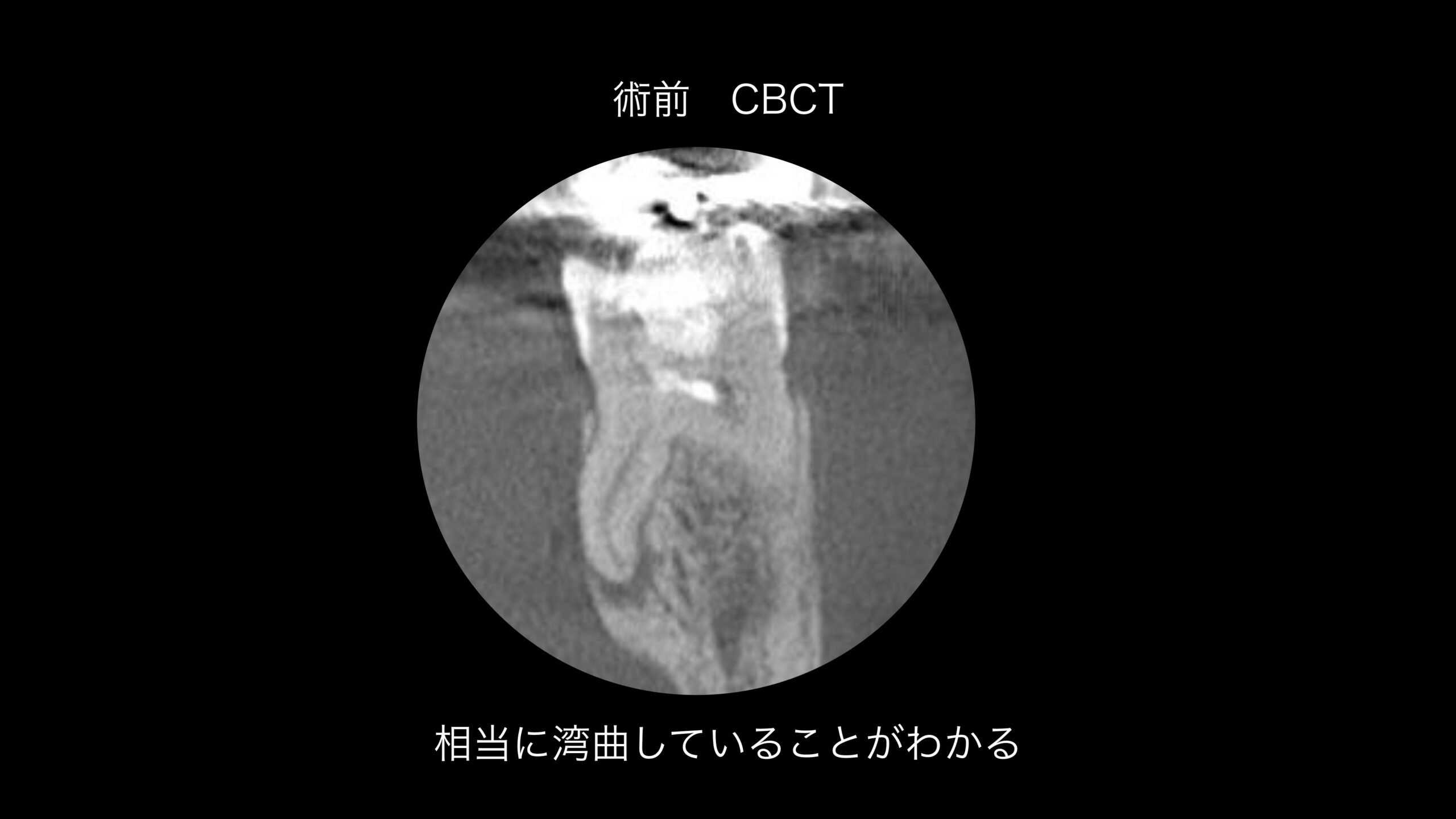 小岩（東京都江戸川区）の歯医者、笠原デンタルオフィスのインプラント症例