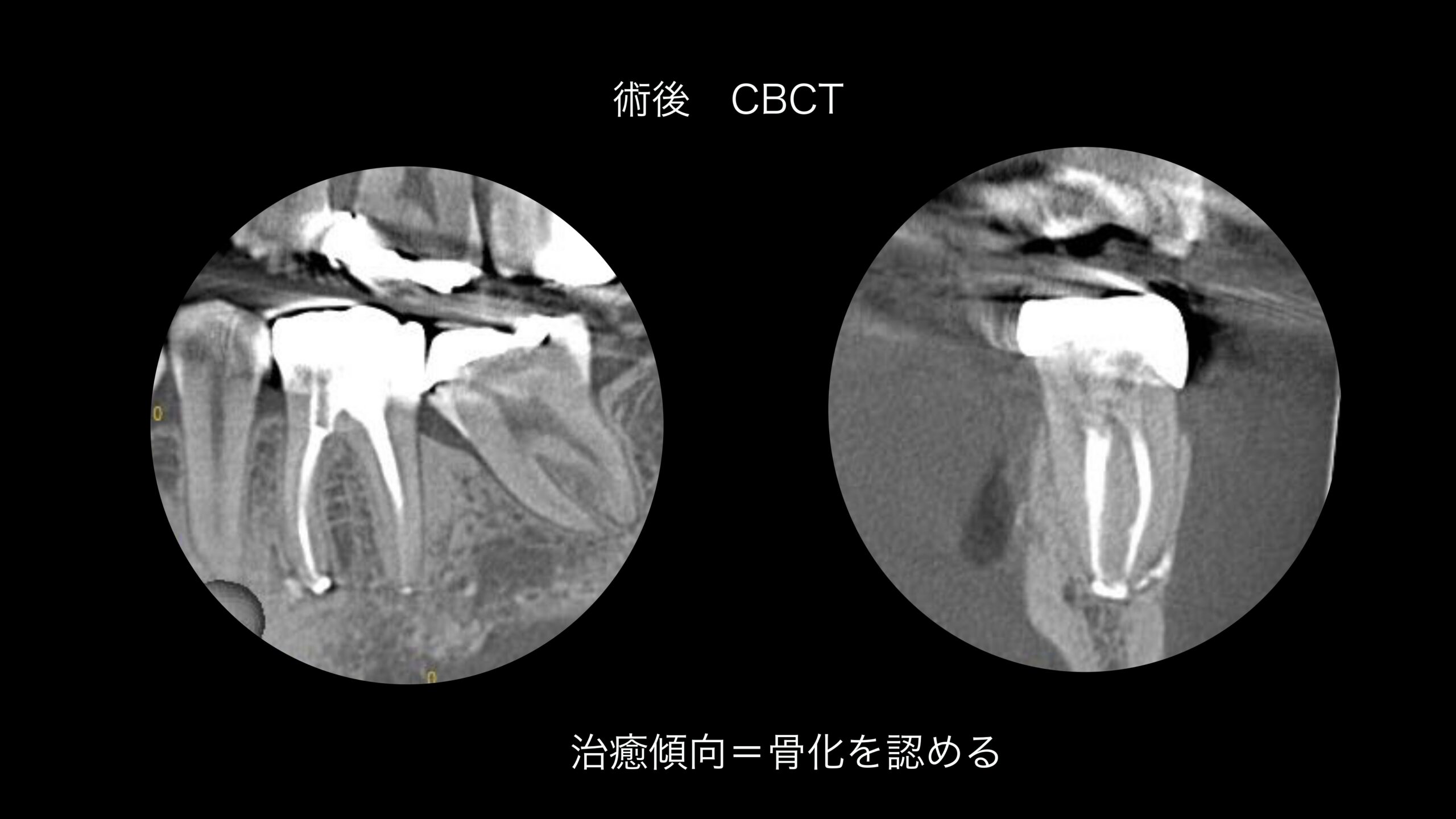 小岩（東京都江戸川区）の歯医者、笠原デンタルオフィスのインプラント症例