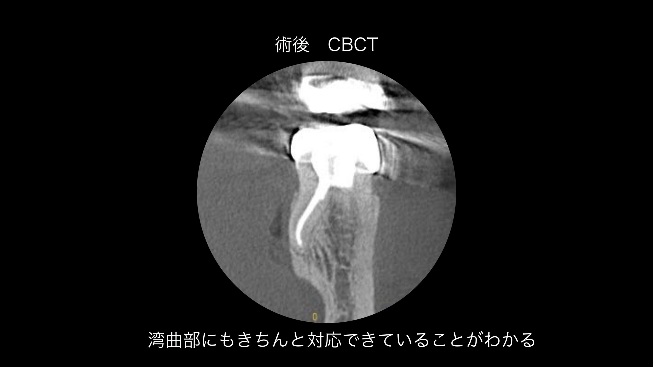 小岩（東京都江戸川区）の歯医者、笠原デンタルオフィスのインプラント症例