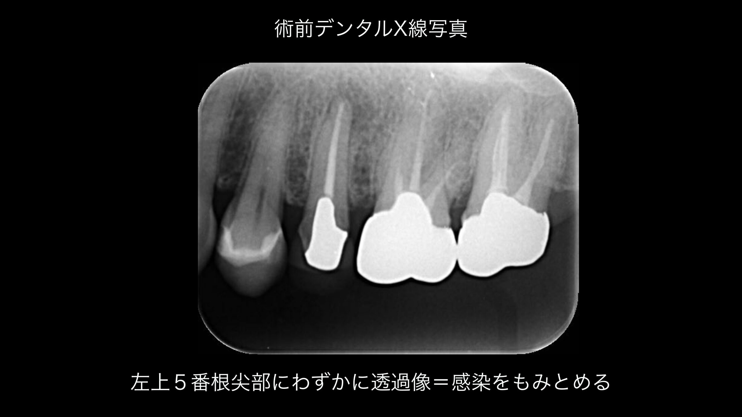 小岩（東京都江戸川区）の歯医者、笠原デンタルオフィスのインプラント症例