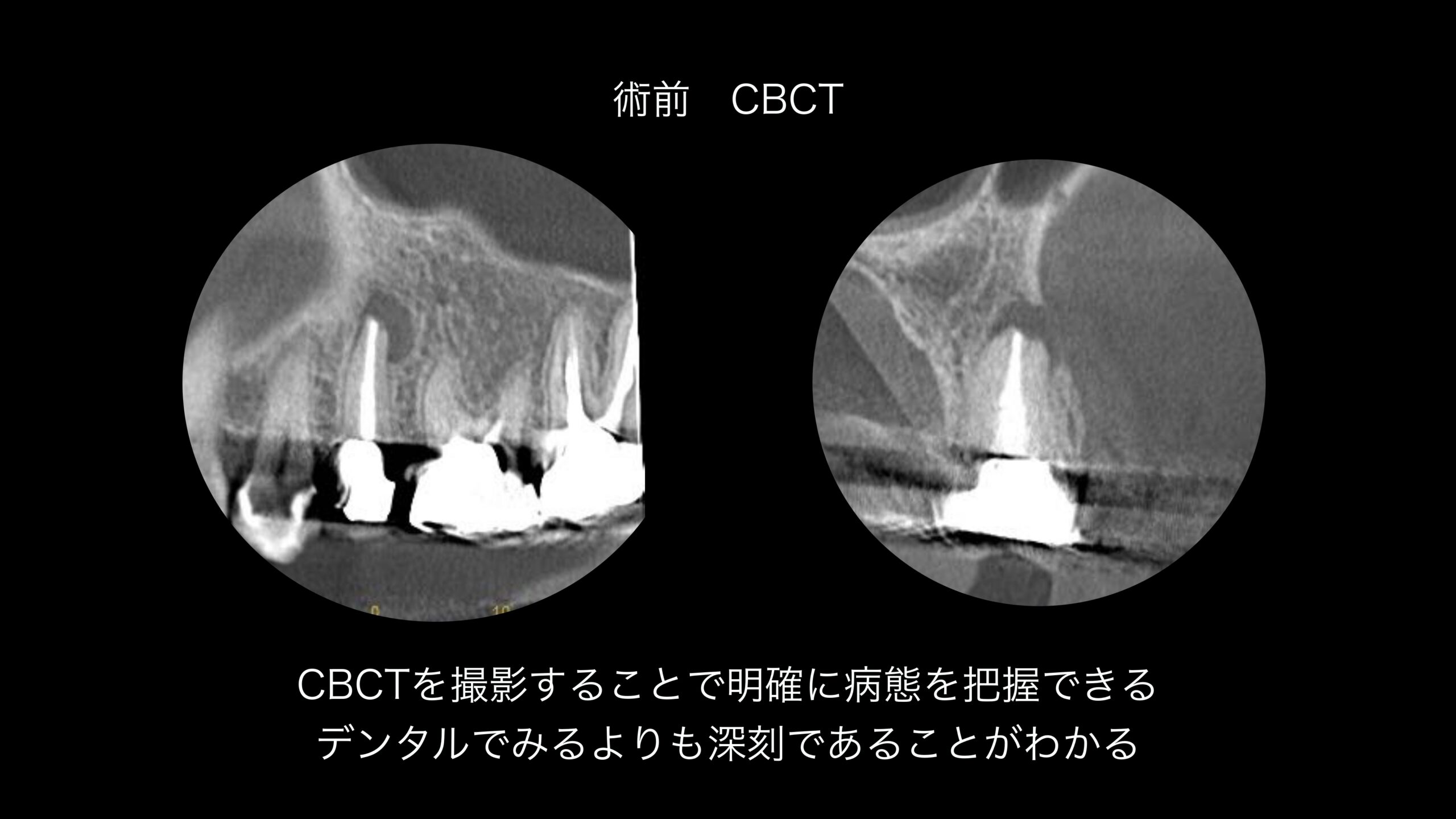 小岩（東京都江戸川区）の歯医者、笠原デンタルオフィスのインプラント症例