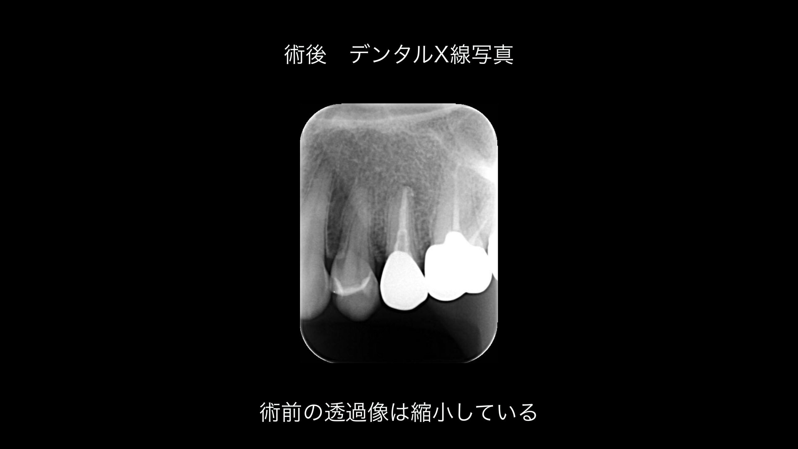 小岩（東京都江戸川区）の歯医者、笠原デンタルオフィスのインプラント症例