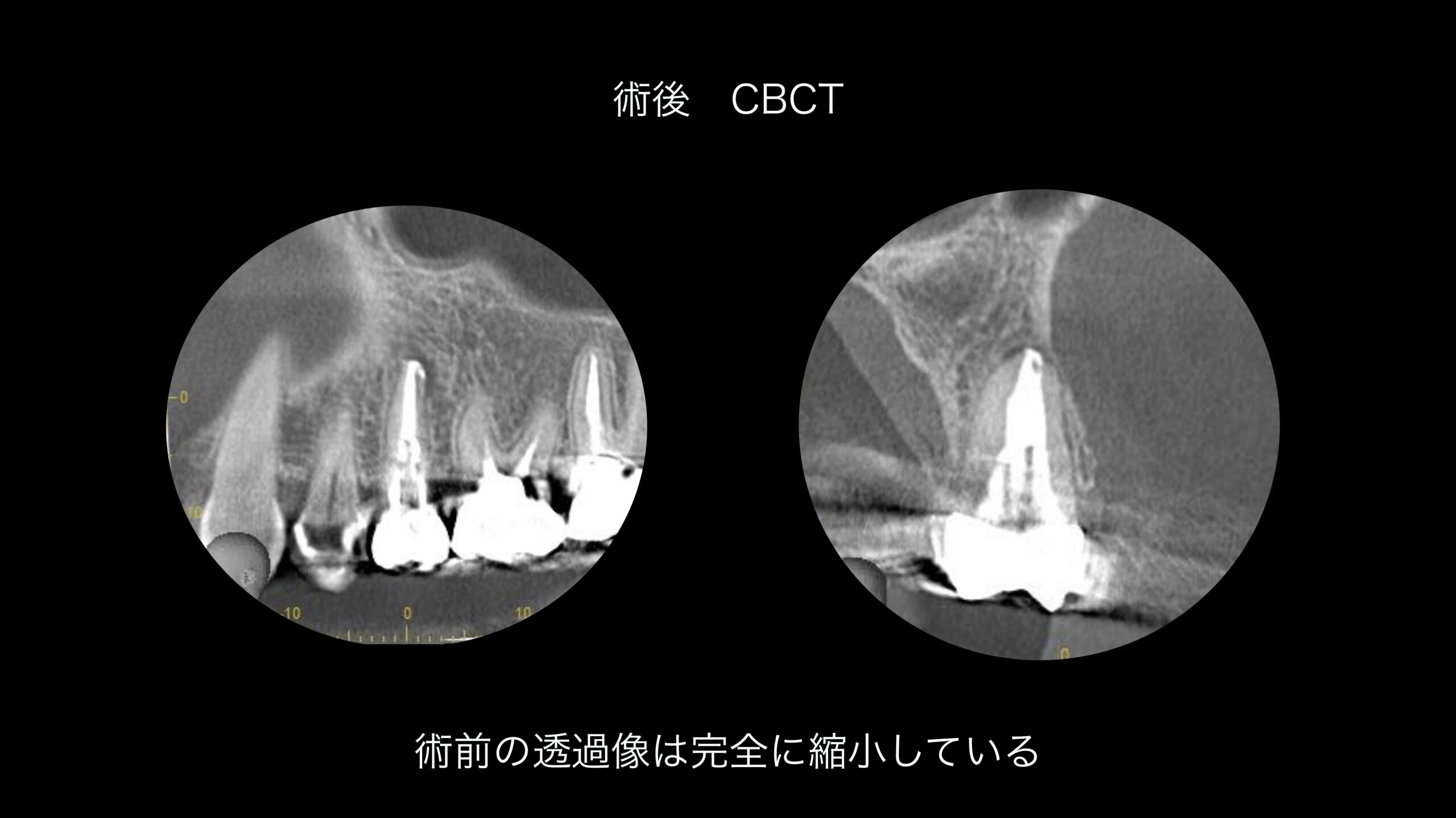 小岩（東京都江戸川区）の歯医者、笠原デンタルオフィスのインプラント症例