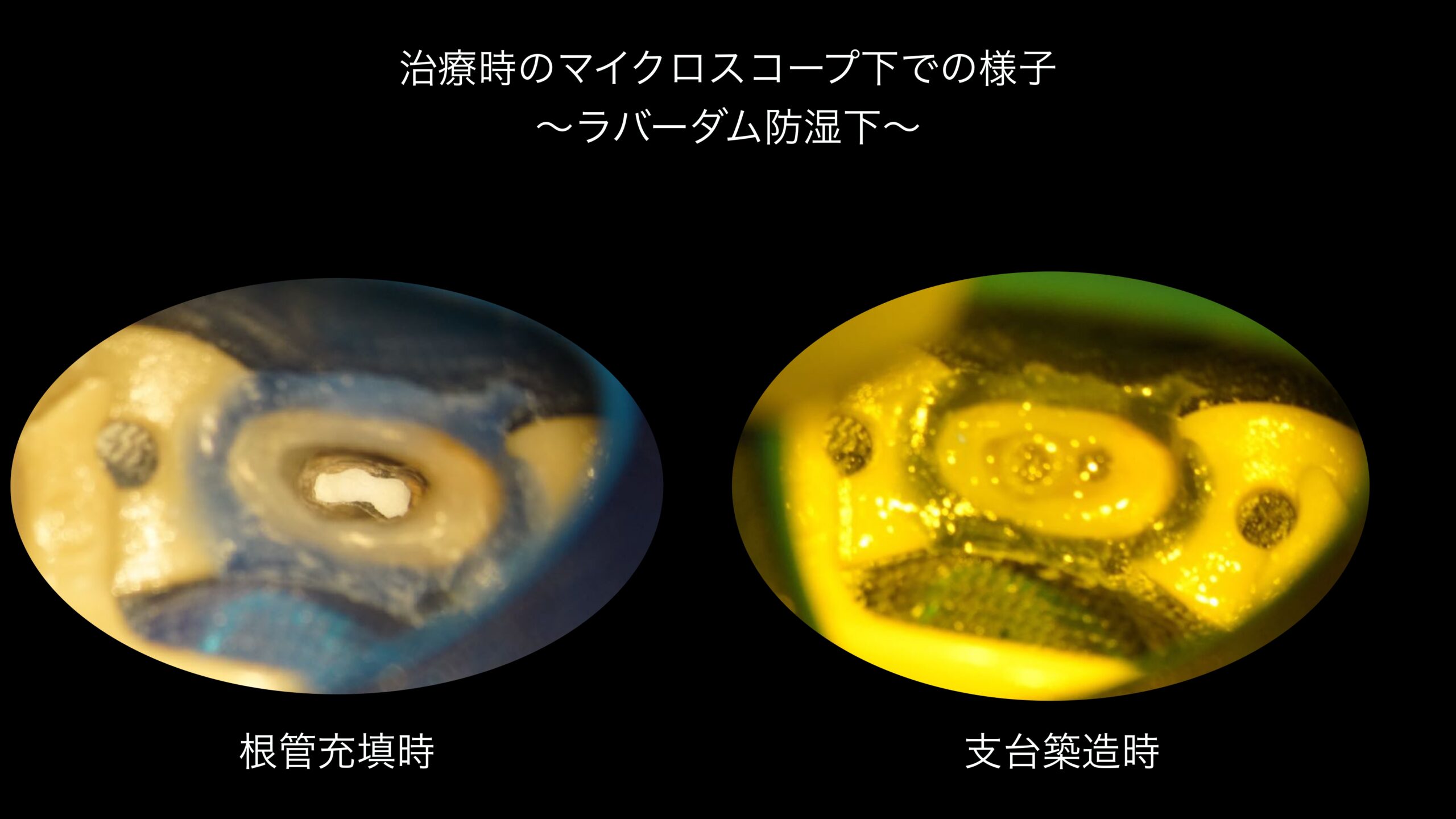 小岩（東京都江戸川区）の歯医者、笠原デンタルオフィスのインプラント症例
